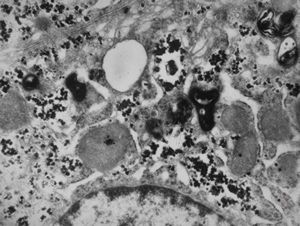 M,13y. | Wilson disease M,13y. | Wilson disease